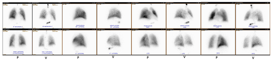 Normal VQ Scan